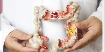 Kolon Kanserinde Beslenme