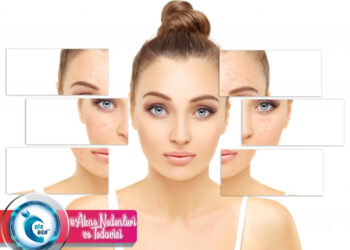 Akne Nedenleri ve Tedavisi