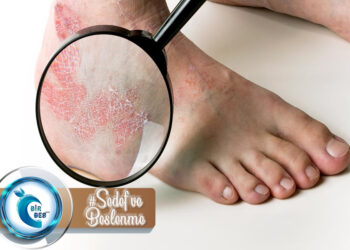 Sedef Hastalığı Nedir? Beslenme Tedavisi Nasıldır?