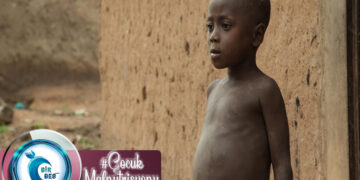 İnsanlığın Ortak Sorunu; Çocuk Malnutrisyonu!