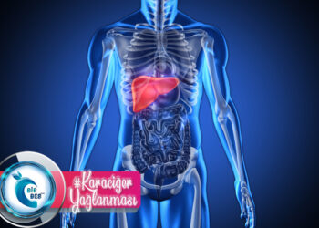 Karaciğer Yağlanması Nedir? Beslenme Tedavisi Nasıldır?