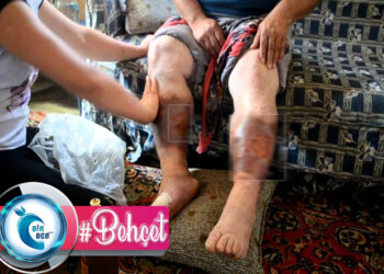 Behçet Hastalığı Nedir? Belirtileri Nelerdir? Tedavisi Nasıldır?