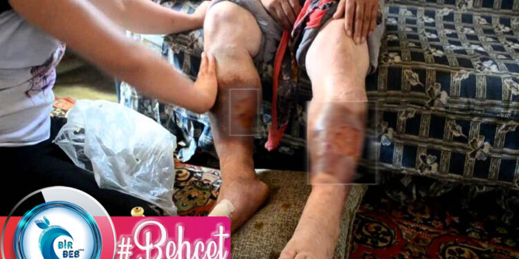 Behçet Hastalığı Nedir? Belirtileri Nelerdir? Tedavisi Nasıldır?