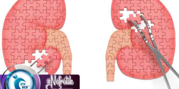 Nefrotik Sendrom Nedir? Tıbbi Beslenme Tedavisi Nasıl Olmalıdır?