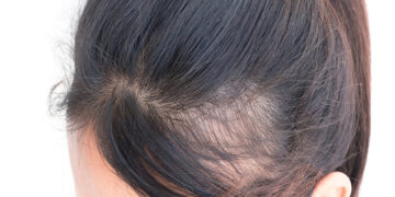 Alopesi (Saç Dökülmesi) Nedir? Beslenmenin Saç Dökülmesine Etkileri Nelerdir?