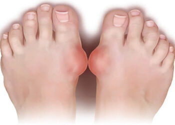 Gut Hastalığı Nedir? Beslenme Tedavisi Nasıl Olmalıdır?