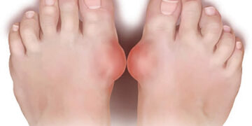 Gut Hastalığı Nedir? Beslenme Tedavisi Nasıl Olmalıdır?