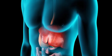 Alkole Bağlı Olmayan Yağlı Karaciğer Hastalığı Nedir? Beslenme Tedavisi Nasıl Olmalıdır?