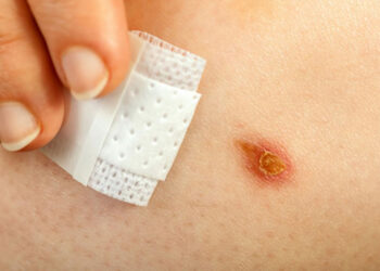 Yara İyileşmesi Nedir? Kaç Evrede Tamamlanır? Beslenme Tedavisi Nasıl Olmalıdır?