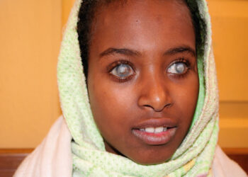 Gece Körlüğü Nedir? Nasıl Oluşur? Belirtileri Nelerdir? Tedavisi Nasıldır?