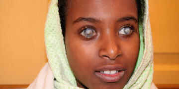 Gece Körlüğü Nedir? Nasıl Oluşur? Belirtileri Nelerdir? Tedavisi Nasıldır?