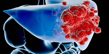 Hepatosellüler Karsinoma (HCC) Nedir? Nasıl Oluşur? Tedavisi Nasıldır?