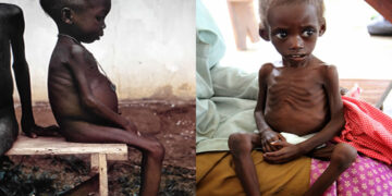 Kalori Malnutrisyonu (Marasmus) Ve Stres Açlığı (Kwashiorkor) Nedir? Sebepleri Nelerdir?