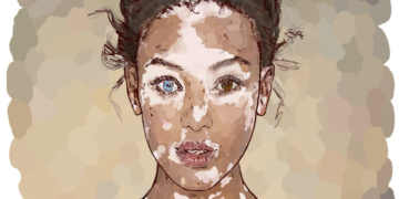 Vitiligo Nedir? Neden Olur? Belirtileri ve Çeşitleri Nelerdir? Vitiligo’da Beslenme Nasıl Olmalıdır?