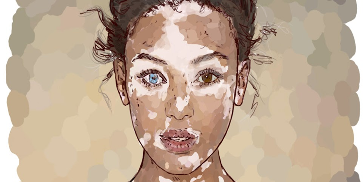 Vitiligo Nedir? Neden Olur? Belirtileri ve Çeşitleri Nelerdir? Vitiligo’da Beslenme Nasıl Olmalıdır?