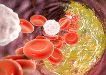 Ateroskleroz (Damar Sertleşmesi) Nedir? Risk Faktörleri Nelerdir? Beslenme Tedavisi Nasıl Olmalıdır?