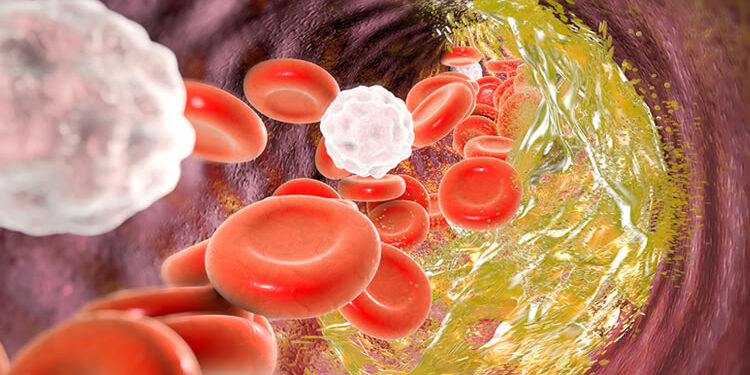 Ateroskleroz (Damar Sertleşmesi) Nedir? Risk Faktörleri Nelerdir? Beslenme Tedavisi Nasıl Olmalıdır?