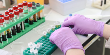 Hiperlipoproteinemi Nedir? Çeşitleri Nelerdir? Beslenme Tedavisi Nasıl Olmalıdır?