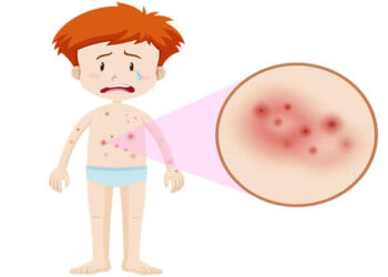 Egzama Nedir? Neden Oluşur? Beslenme Tedavisi Nasıldır?