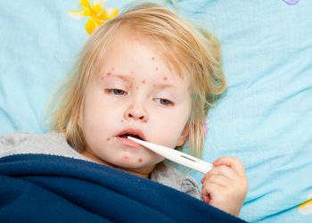 Kızamık Nedir? Belirtileri Nelerdir? Nasıl Tedavi Edilir?