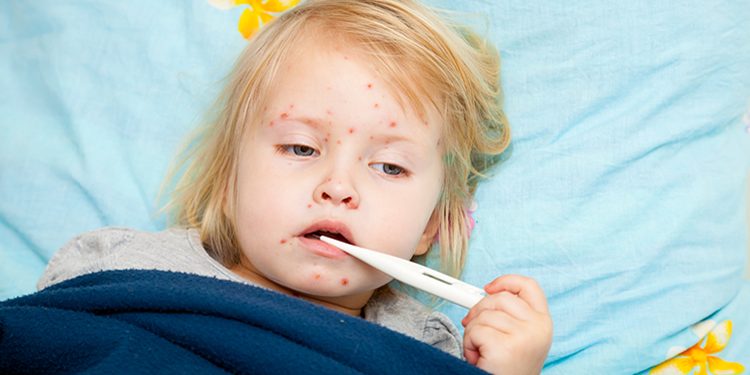 Kızamık Nedir? Belirtileri Nelerdir? Nasıl Tedavi Edilir?